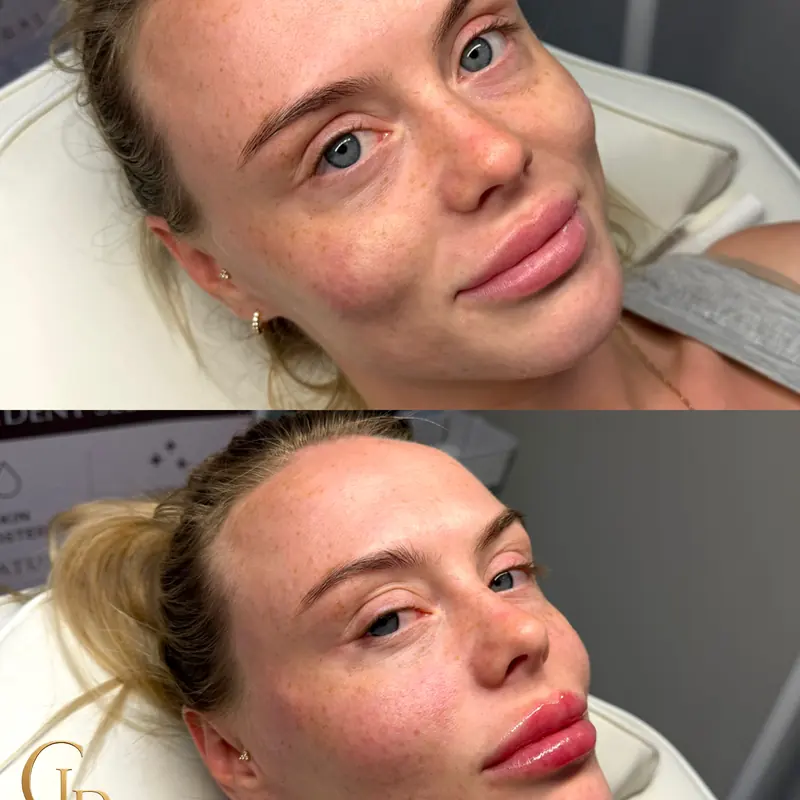 Before and after lip filler with Haus of CLB